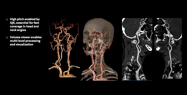 КТ-ангиография головы и шеи