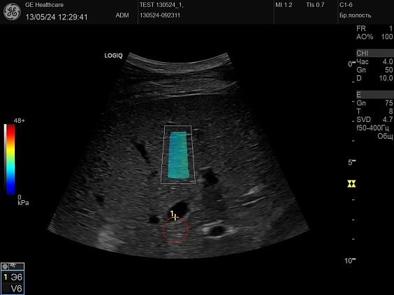 GE HealthCare Logiq P10 ультразвуковой аппарат