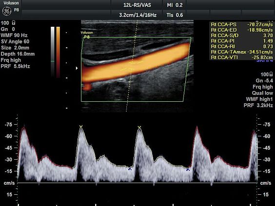 Voluson P8 аппарат УЗИ GE HealthCare